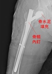 九旬翁髖部骨折　髓內釘搭配骨水泥治療6天出院可行走
