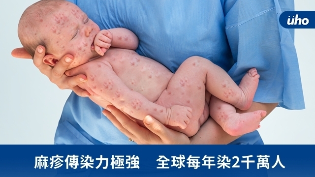 麻疹傳染力極強　全球每年染2千萬人
