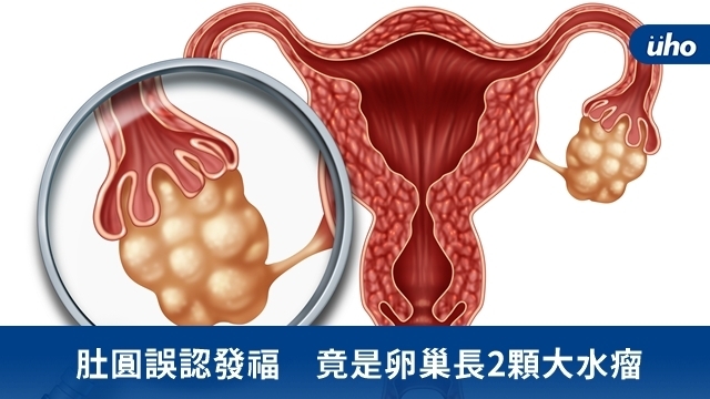 肚圓誤認發福　竟是卵巢長2顆大水瘤