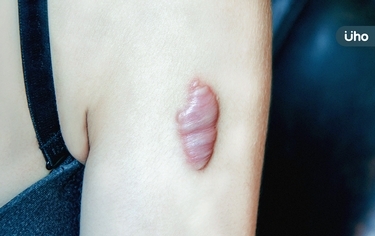 傷口疤痕感染「蟹足腫」如背長巨蟲！醫揭好發部位「2招」可預防