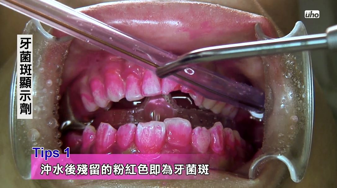 利用牙菌斑顯示劑把牙菌斑染出來，這些被染成粉紅色的都是牙菌斑