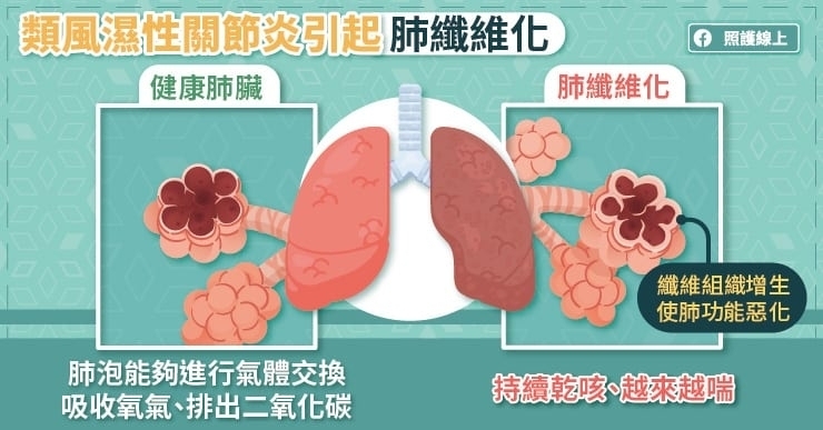 類風濕性關節炎引起肺臟發炎、肺纖維化