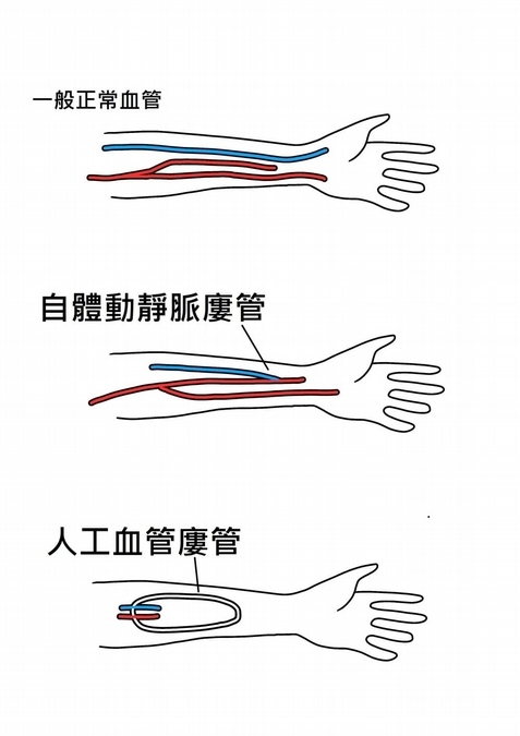 什麼是自體動靜脈婁管（AVF）？