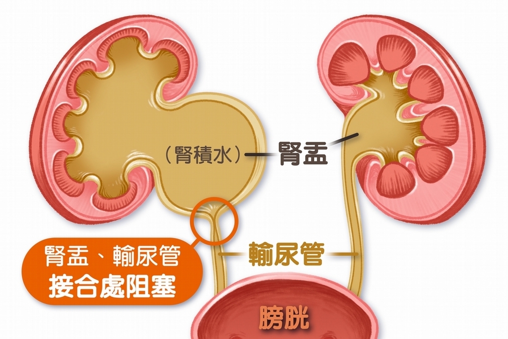 右腎早已沒有功能，摘除免受煎熬