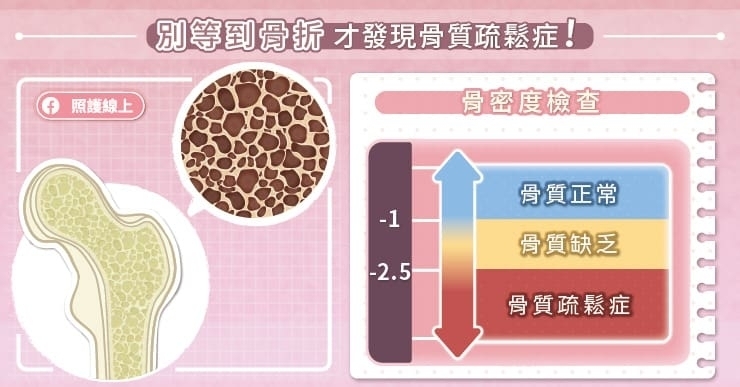 別等到骨折才發現骨質疏鬆症！