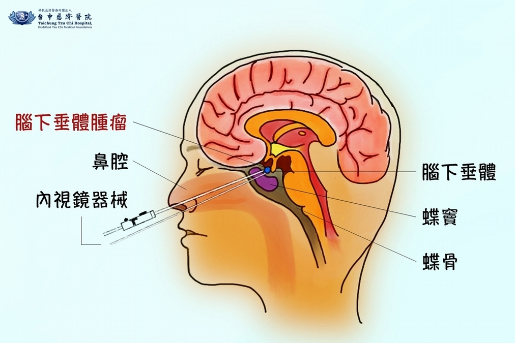 腦下垂體腫瘤栓塞的危險徵兆