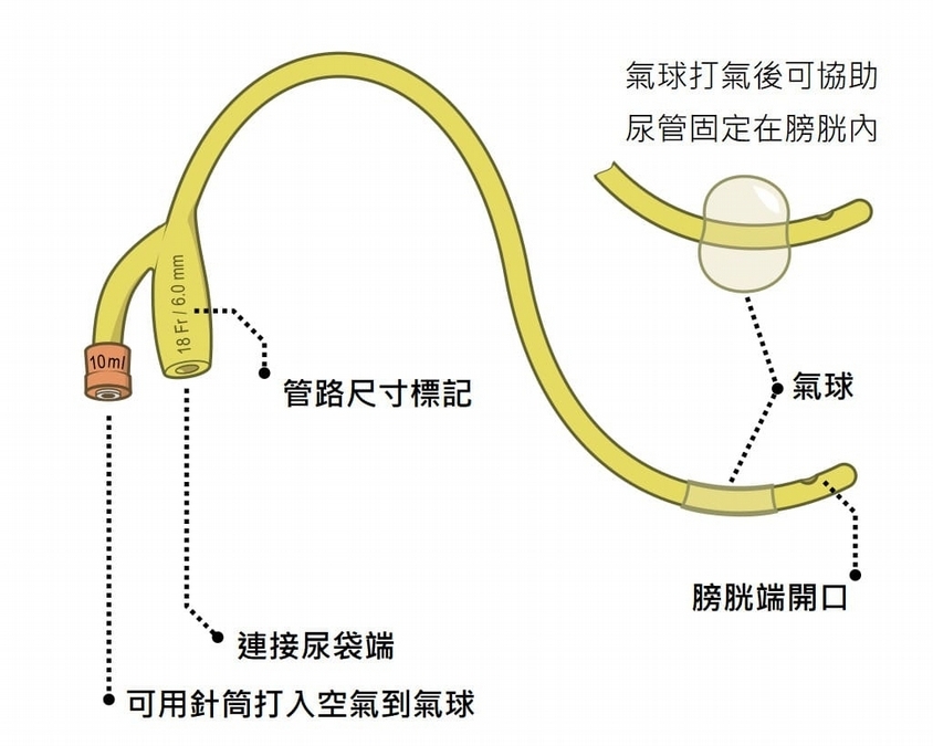 導尿的種類