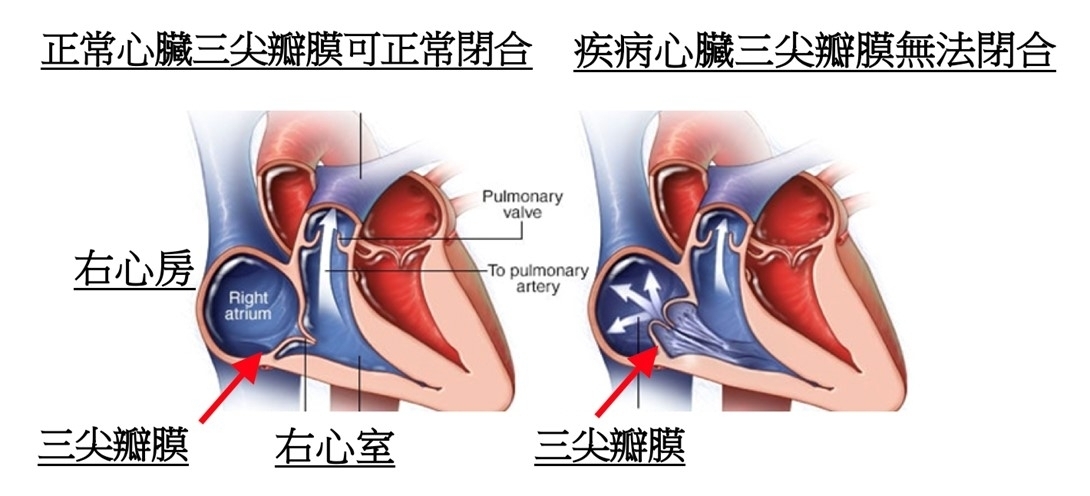 三尖瓣膜逆流是什麼？