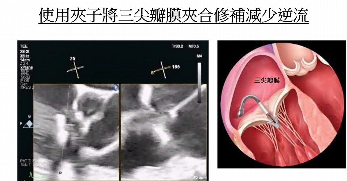 高風險患者需要更安全有效地治療