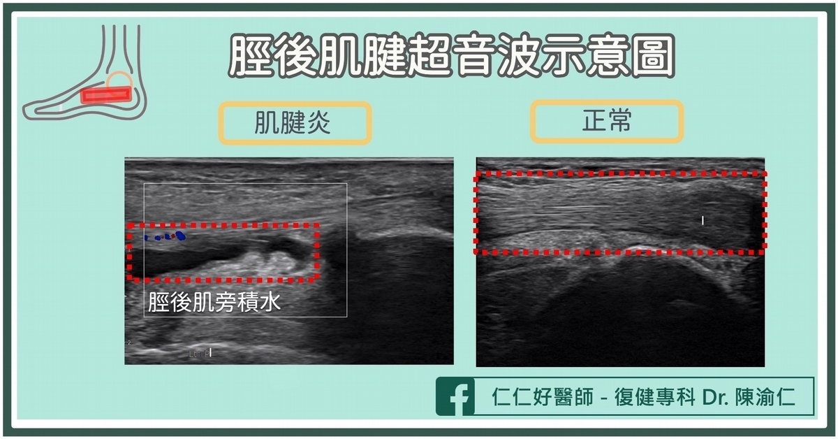 什麼是「脛後肌腱失能」？