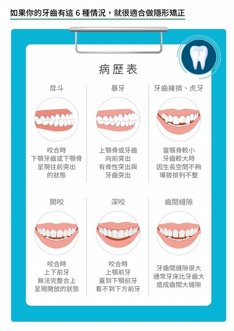 這6種情況適合做隱形矯正