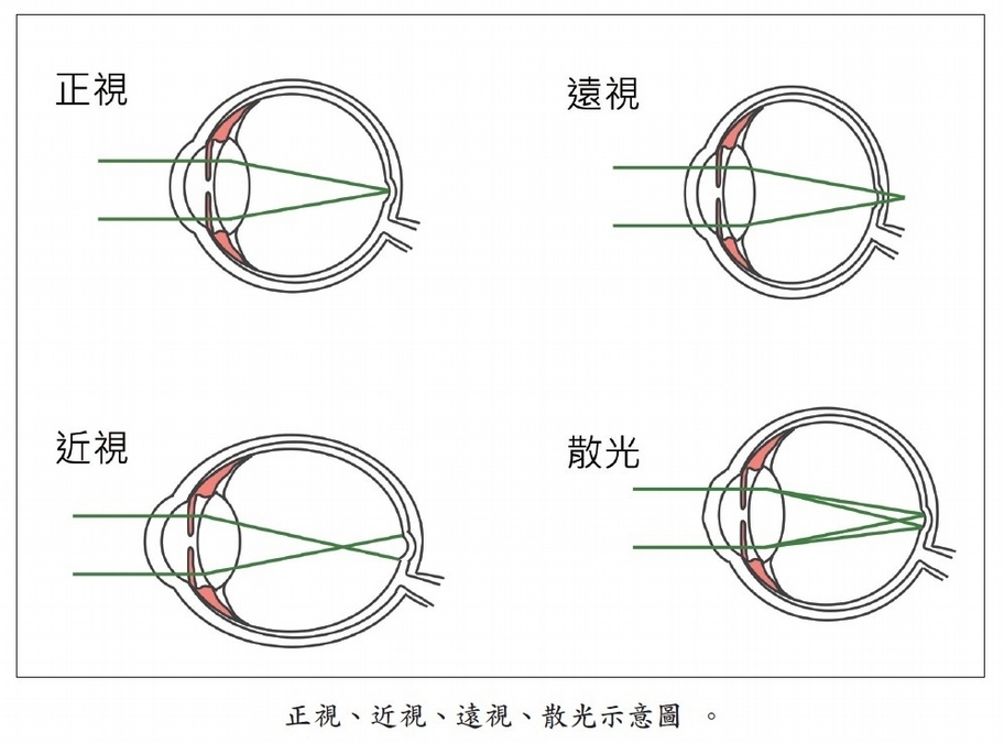 弱視、遠視、散光的差別？