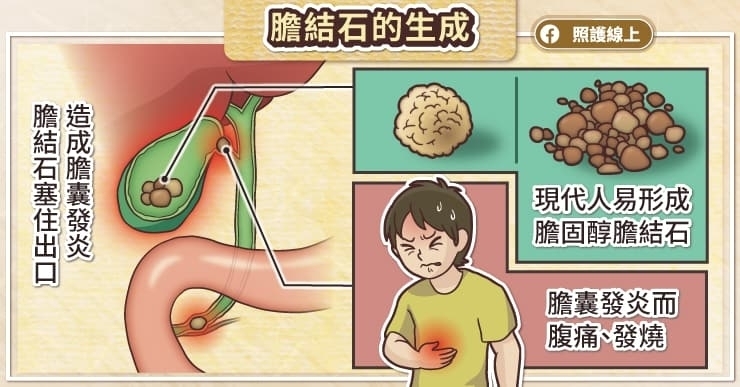 膽結石是什麼？