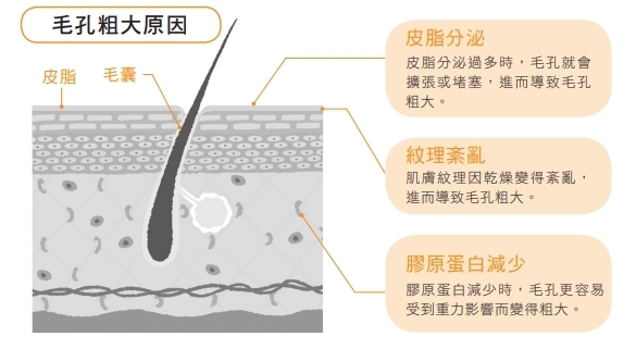 毛孔粗大的主因