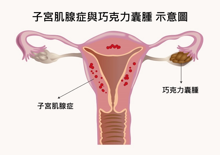 子宮內膜異位症無法根治