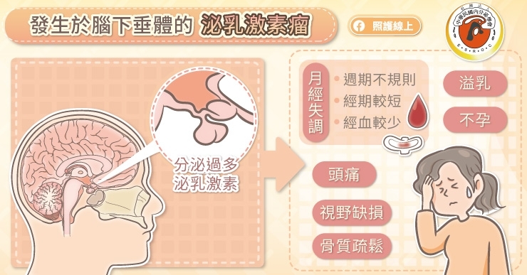 泌乳激素瘤常見症狀有哪些？