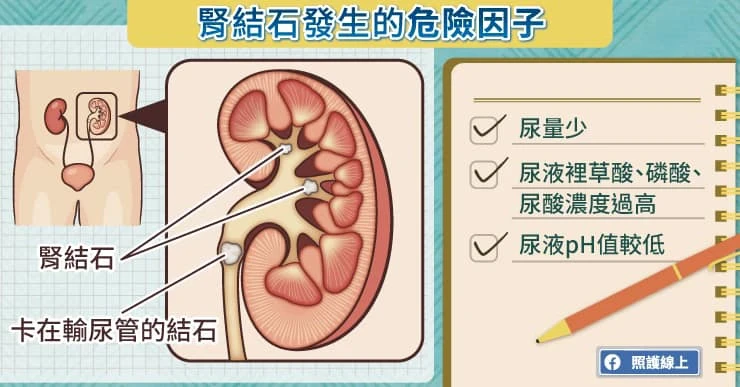 腎結石的發生