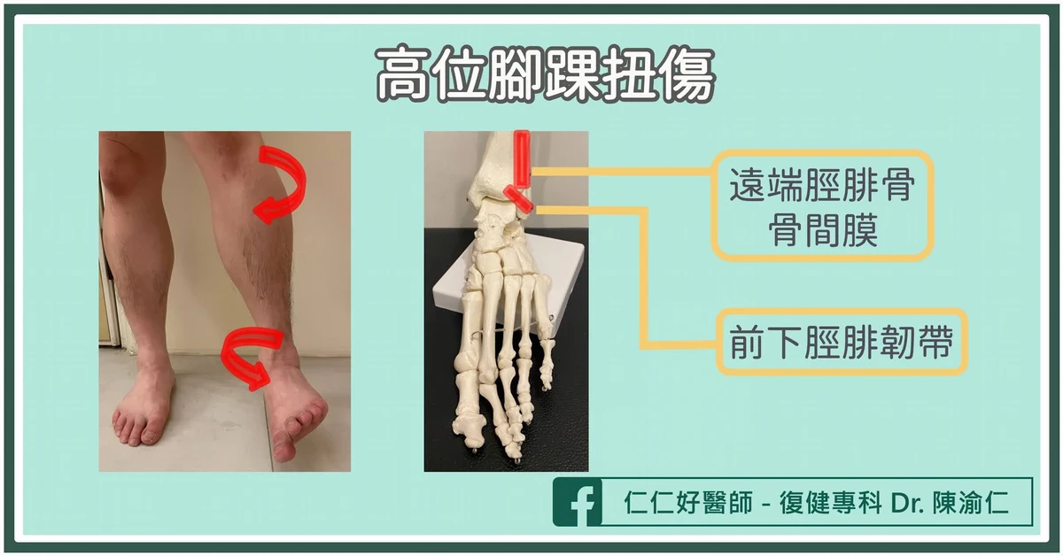 3. 高位腳踝扭傷