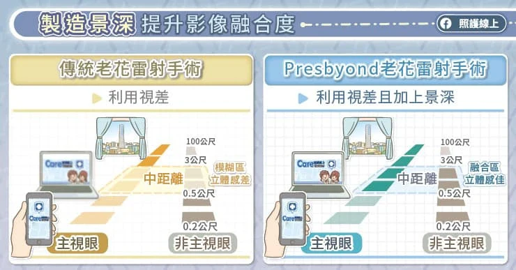 Presbyond LBV老花雷射手術步驟