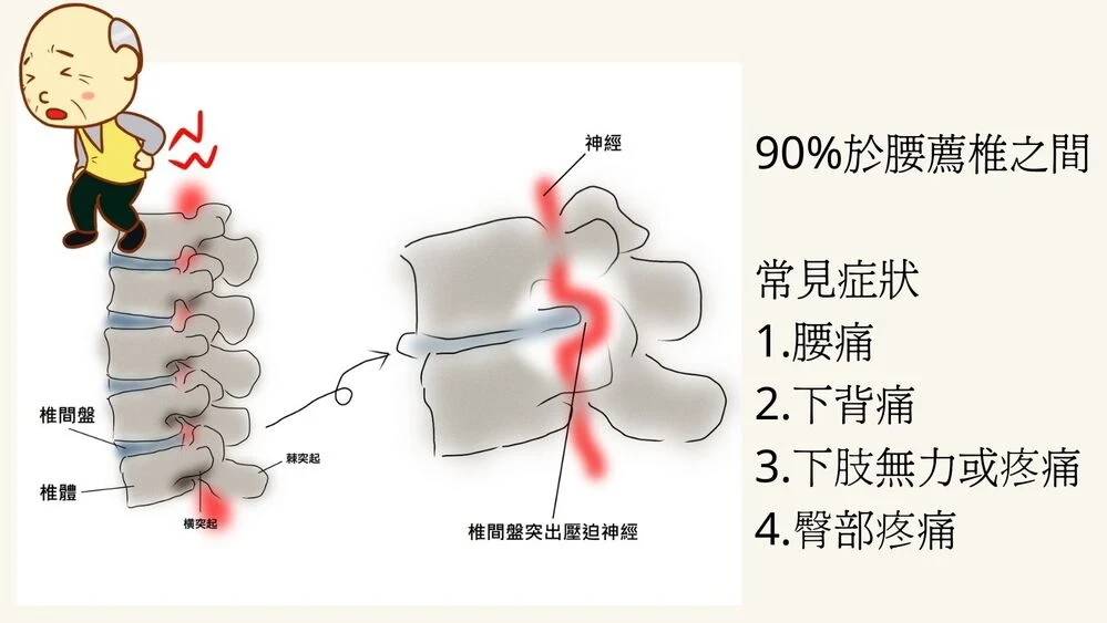 椎間盤突出好發位置