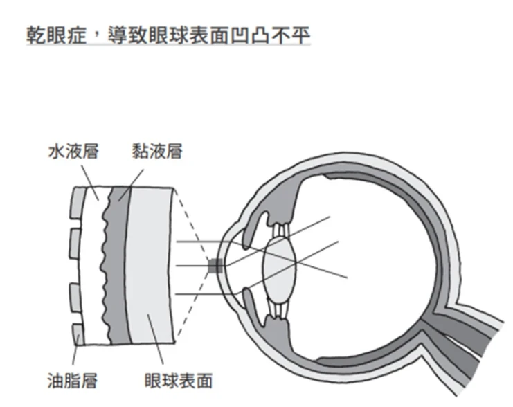 眼睛乾澀好疲勞，拼命點人工淚液？醫教「毛巾熱敷法」5分鐘能舒緩