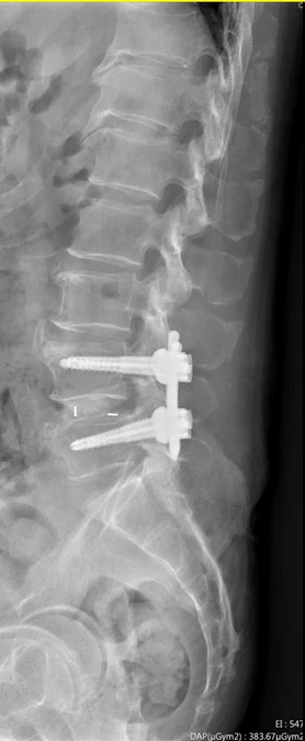 腰椎一動就痛像針在扎，竟是「脊椎錯位」！醫揭「4原因」最常見