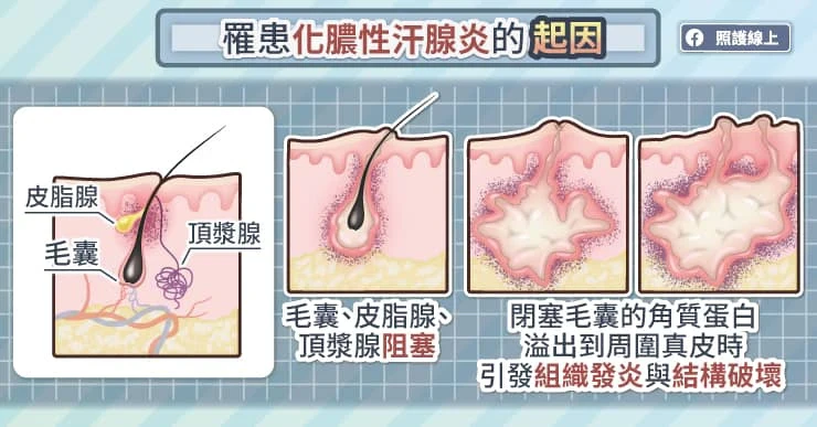 罹患化膿性汗腺炎的起因