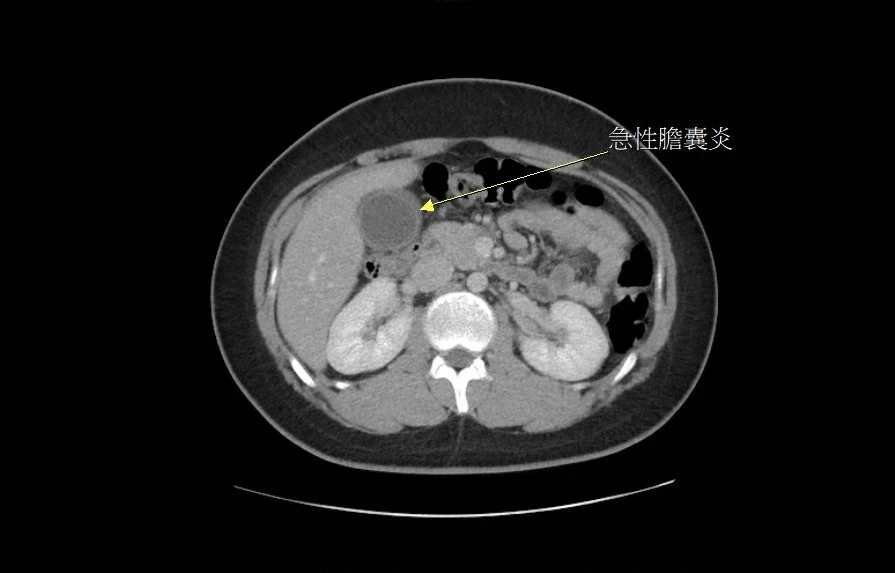 膽結石上腹痛恐誤以為胃痛