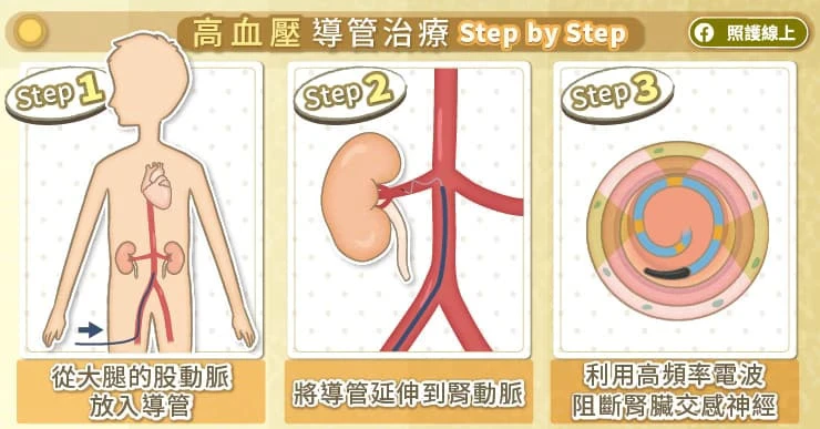 高血壓導管治療步驟