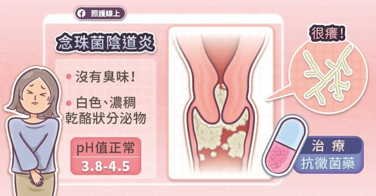 1. 念珠菌陰道炎（Candida vaginitis）