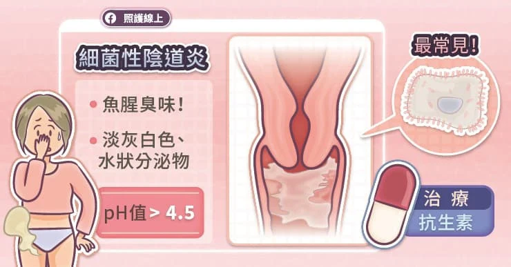 2. 細菌性陰道炎（Bacterial vaginosis）