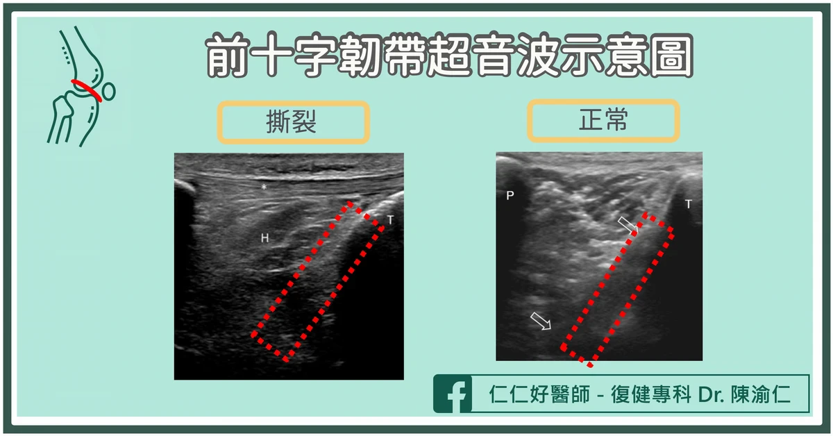 如何檢查前十字韌帶受傷？