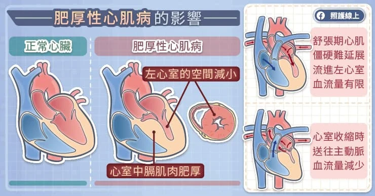 心臟肌肉變肥厚會怎樣？