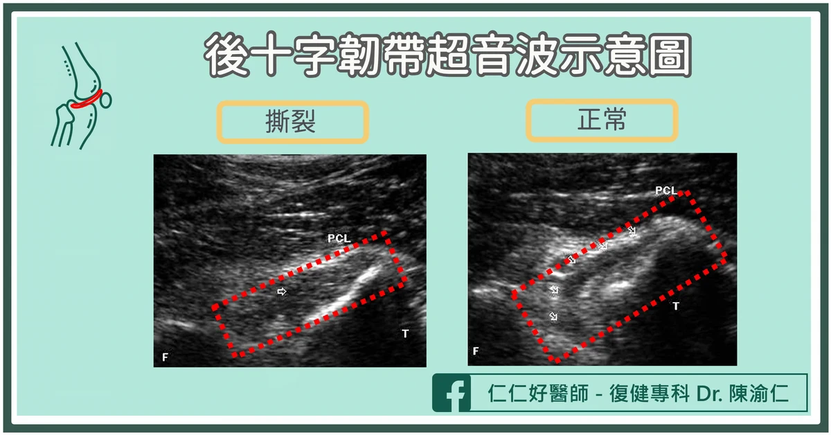 如何判斷後十字韌帶受傷？