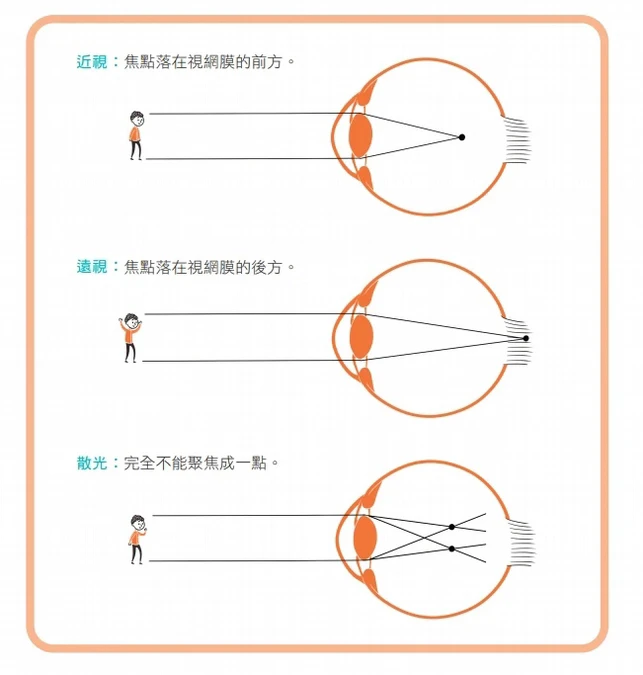 屈光不正：真的看不清楚了