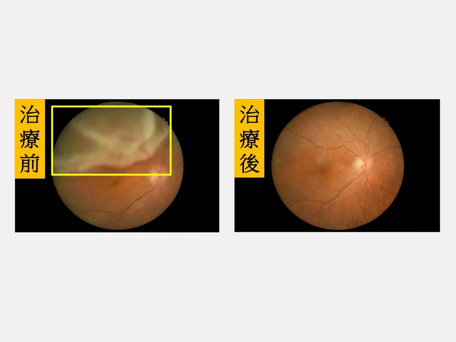 出現閃光、飛蚊症快就醫