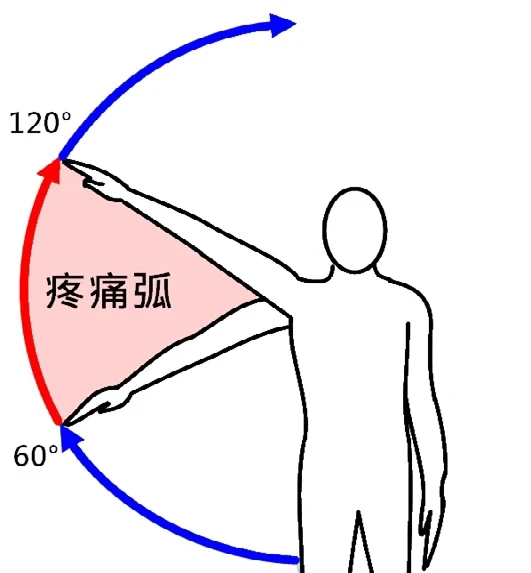 肩夾擠症候群的症狀與診斷