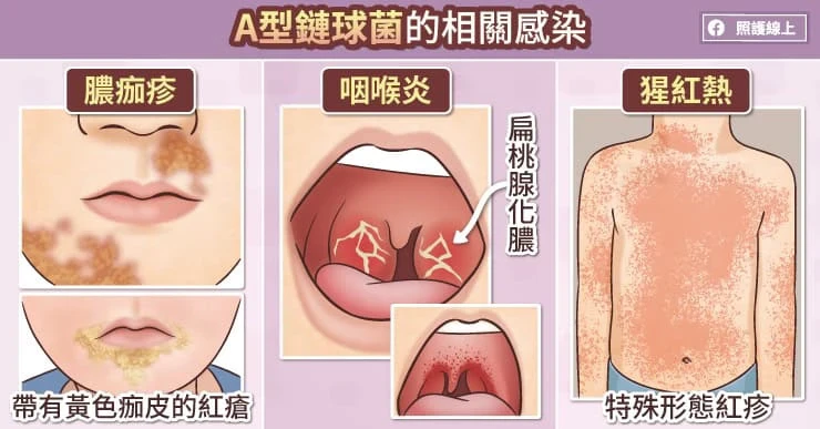 鏈球菌感染後腎小球腎炎