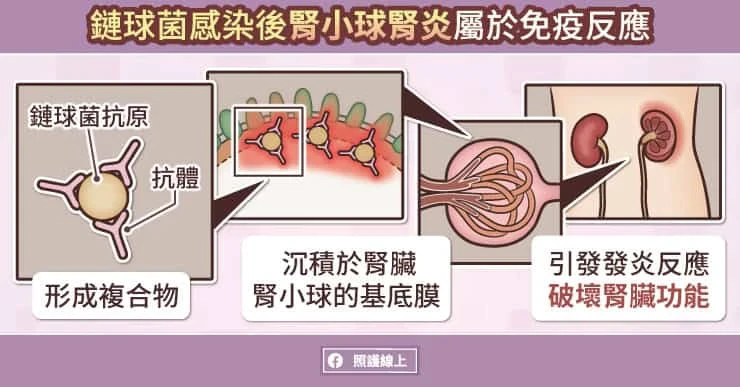 「鏈球菌感染後腎小球腎炎」屬免疫反應