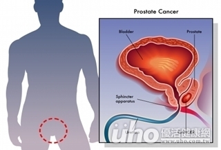 防攝護腺癌　40歲起應每年指診