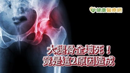 大腿骨全壞死！竟是這2原因造成　疼痛不容忽視