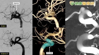 防《機智醫生生活》劇情真實上演 「這手術」治腦動脈瘤