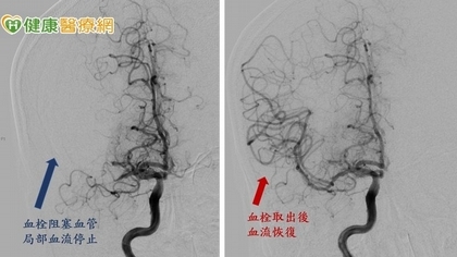 少年腦中風路倒　顱內動脈取栓術撿回一命