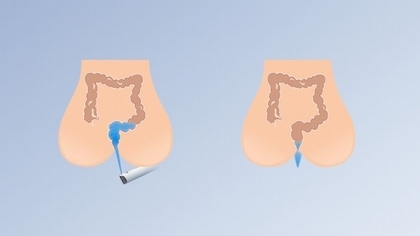 便祕難以啟齒? 日常「腸道照護」低調改善