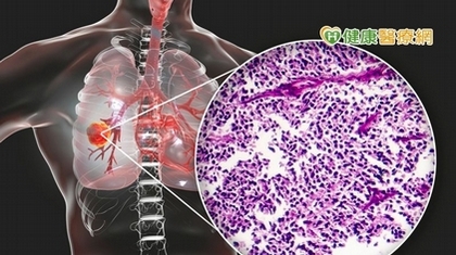 曾1個月內全身佈滿腫瘤　小細胞肺癌患者靠「這個」延命