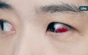 眼睛紅有分泌物、視力模糊⋯醫揭恐是「3急症警訊」嚴重當心失明