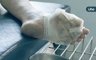 她糖尿病「足部潰傷」異味竟引老鼠啃!醫揭恐怖真相:嚴重恐截肢