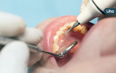 牙齦發炎、牙鬆咬不動快就醫！牙醫警告「這4症狀」恐是牙周病作祟