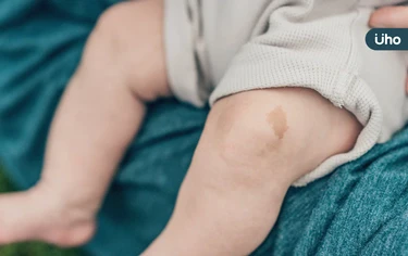 孩子身上長斑點，是胎記還是「咖啡牛奶斑」？醫揭神經纖維瘤2類型