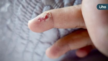 指甲傷口老是好不了 可不能輕忽 小心可能是皮膚癌